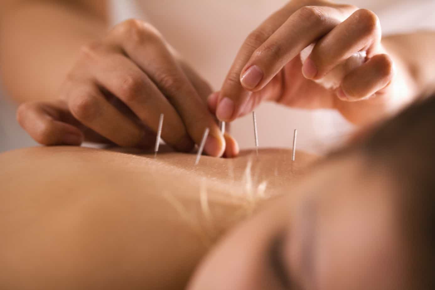 acupuncture treatment photo